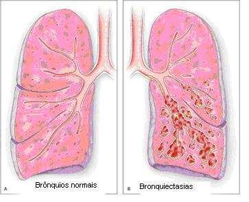 Bronquiectasia Conceito: Doença infecciosa crônica onde ocorre uma dilatação anormal dos brônquios e bronquíolos.