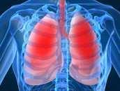 Pneumonia Conceito: Infecção do tecido pulmonar.
