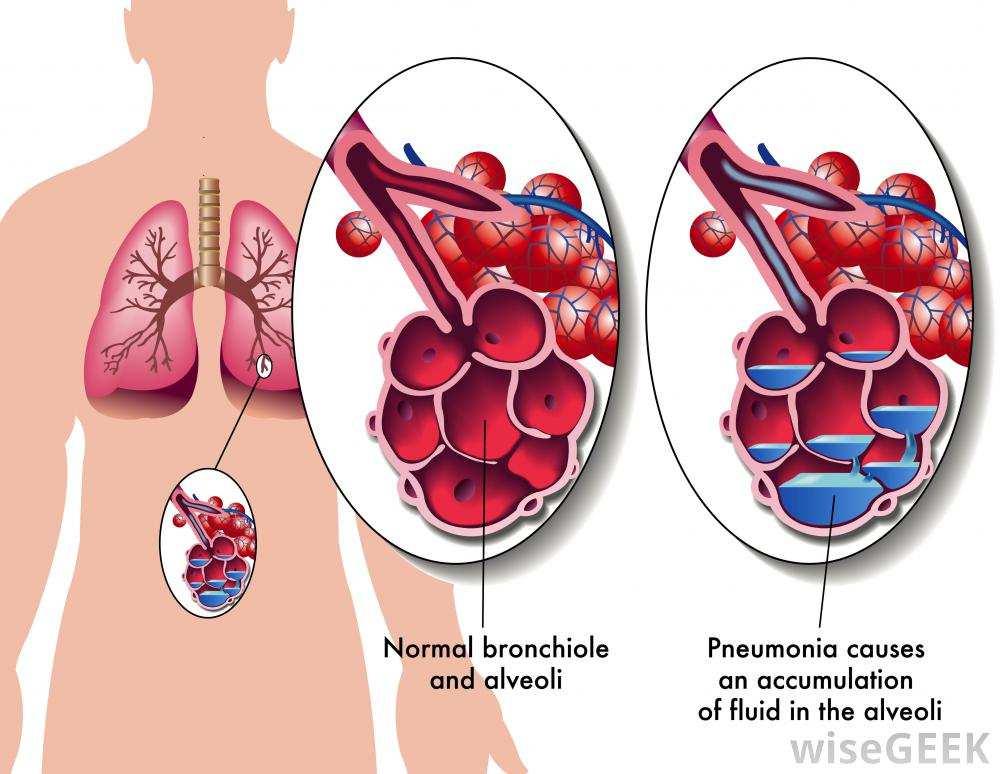 Pneumonia Causas: Em pacientes acamados, ela pode ainda ocorrer, devido ao acúmulo e secreções (pneumonia hipostática) penetração de corpos estranhos