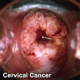 TROPISMO Tipos genitais ~ 200 Tipos de HPV HPV