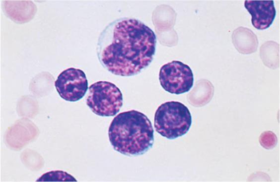 24 FIGURA 3. Linfoblastos. Grande relação entre núcleo-citoplasma e não possuem grânulos citoplasmáticos.