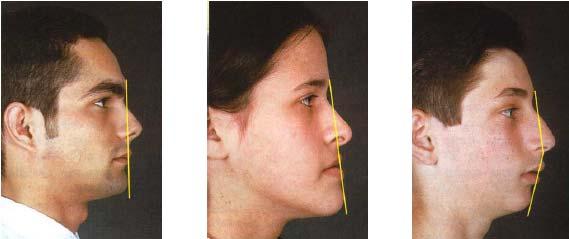 Figura 4 - Proporções faciais transversais - "regra dos quintos Quanto à vista sagital, avaliamos o perfil facial através do ângulo formado entre os seguintes pontos: glabela, subnasal e porion.