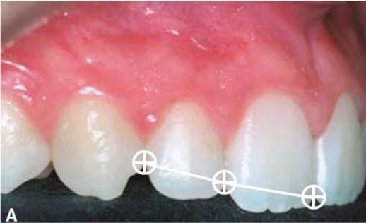 Figura 14- Inclinação dentária mesial (Adaptado de Gaarone et al., 2003) V.