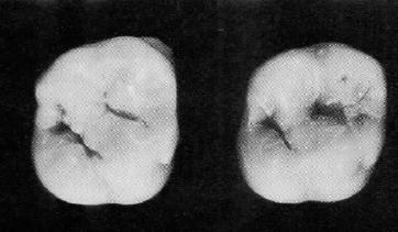 mesio-vestibular. Esta estrutura é típica no primeiro pré-molar inferior e no primeiro molar superior.