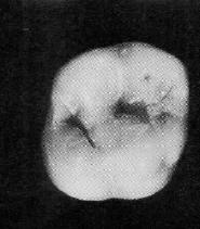 Tubérculo- Evidencia-se uma saliência sem forma definida é comum visualizarse o tubérculo de Carabelli no primeiro molar