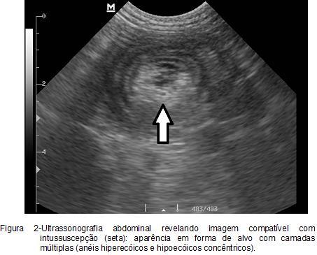 Os exames laboratoriais revelaram ausência de alterações em séria vermelha, leucocitose absoluta por neutrofilia moderada, e proteínas plasmáticas totais discretamente elevadas.