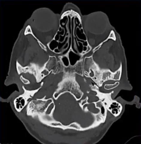 Osso Zigomático Côndilo mandibular Osso petroso