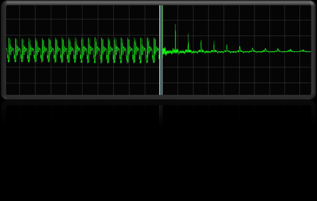 49 Figura 8 No primeiro quadro observa-se a onda do sinal sonoro e no segundo quadro os picos da autocorrelação do sinal residual, sendo que a partir do segundo pico, circulado na imagem, se calcula