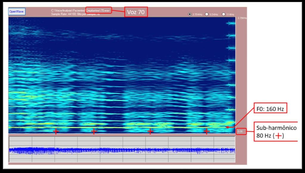 51 Hz. Na parte B observa-se, após indicação da F 0 calculada pelo clínico, que o programa encontra a F 0 de 165,2 Hz e identifica corretamente os períodos do sinal de voz na autocorrelação do sinal.
