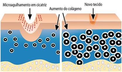 Figura 2: Representação esquemática do aumento na produção de colágeno decorrente do Microagulhamento no tecido cutâneo. Fonte: http://clinicalegerrj.com.br/images/dermaroller-cicatriz.jpg.