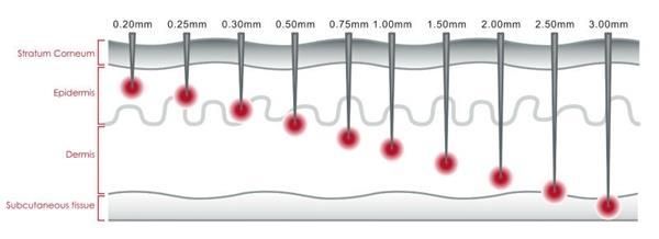 esteticistas. Até 1,5 mm por fisioterapeutas, biomédicos e enfermeiros e acima de 2,0 mm apenas por médicos. Figura 1 -Tamanho das agulhas. Fonte: Clínica Wulkan (n.