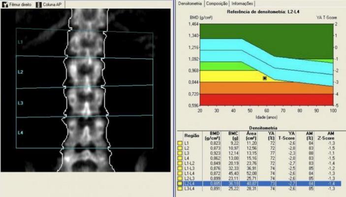 Diagnóstico Densitometria Óssea com Dupla Emissão de Raio X -