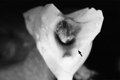 B - opacidades branca e amarronzada vistas no esmalte e desmineralização dentinária amarronzada (com aspecto cônico) margeada por esclerose dentinária (seta), havendo correlação entre as lesões de