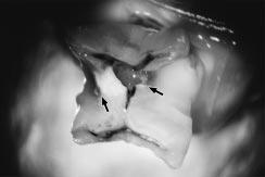 superfície oclusal não afetada mostrada na Figura 3A) e que não houve espalhamento lateral em dentina nas partes retentivas da cavidade.