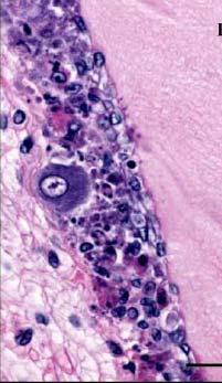 Macroscopicamente os juvenis de Litopenaeus vannamei na fase aguda são frágeis, moribundos, possuem carapaça mole, trato digestivo vazio, expansões difusas dos cromatóforos e os urópodos mostram-se