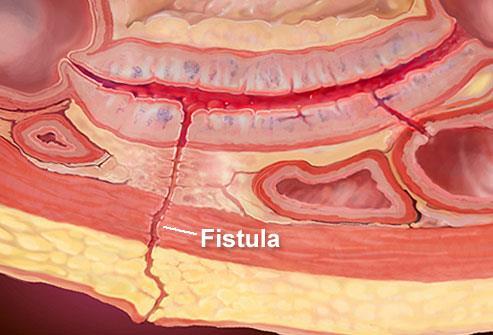 Introdução Fístula e definida como uma comunicación anormal entre dois órgãos ou pele.