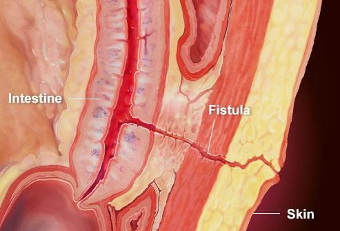 Summary of Best Practice Recommendations for Management od Enterocutaneous Fistulae