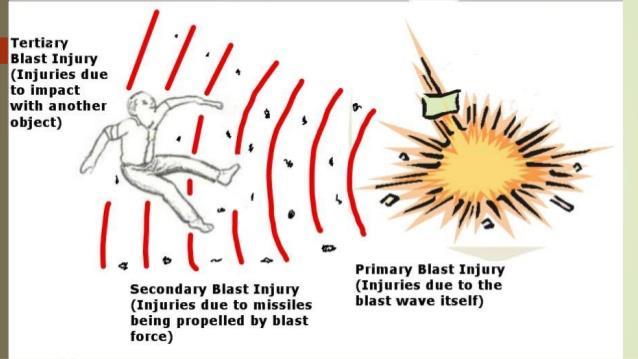 Blast primário: onda de choque Blast secundário: lançamento de fragmentos do explosivo ou outros objetos próximos Blast terciário: impacto com outros
