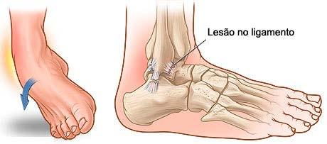 Entorse Lesão nos ligamentos que estão em volta das articulações, fazendo com que a estabilização seja perdida.