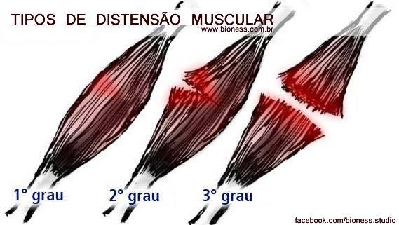 Distensão e Contusão Distensão estiramento,