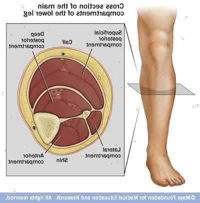 Síndrome Compartimental Ocorre quando a pressão no compartimento ósteo-fascial do músculo é suficiente para produzir isquemia e necrose.