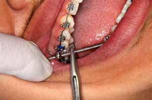 Posteriormente, o tubo telescópico do componente maxilar deve ser encaixado na haste mandibular e com o conjunto