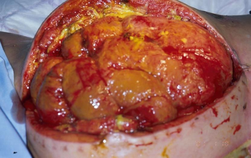 Damage control surgery PREVENIR OU TRATAR A SÍNDROME DO COMPARTIMENTO ABDOMINAL distensão abdominal aumento da PIA oligúria refractária a