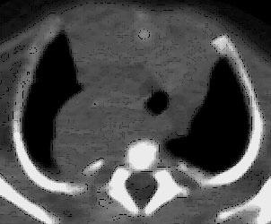 Tumores neurogénicos A grande percentagem deriva das células ganglionares simpáticas e pertencem ao complexo neuroblastoma - ganglioneuroma - ganglioneuroblastoma O neuroblastoma é a forma mais