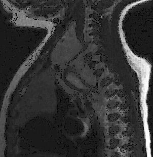 A TC demonstra as lesões, normalmente em localização paravertebral, com densidade de partes moles. As calcificações são frequentes nos neuroblastomas (Fig. 8).