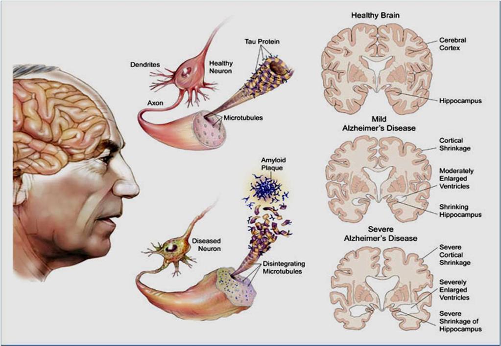 Alzheimer: Formação defeituosa de uma