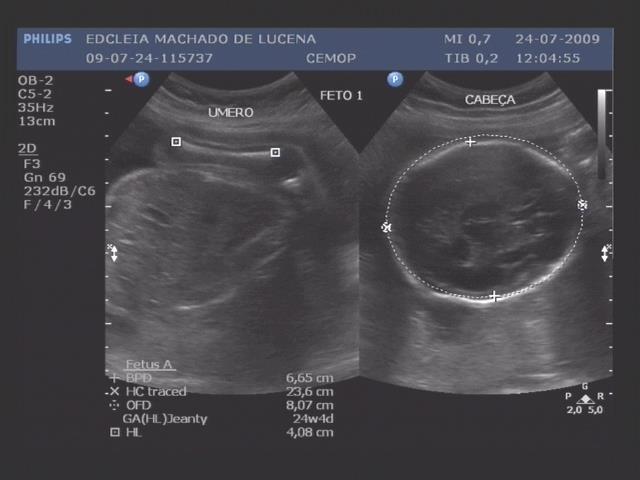 7: Feto 1 Imagem ultrassonográfica demonstrando o fêmur e a circunferência