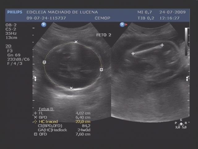 O feto 2, neste estudo ecográfico, apresentou-se com uma frequência cardíaca de 157 bpm,