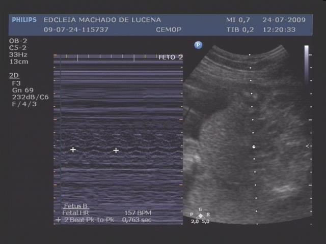 Fig 9: Feto 2 Imagem ultrassonográfica demonstrando o polo cefálico e o fêmur.