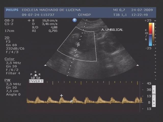 O VLA apresentou-se normal em ambas as cavidades amnióticas e a análise Doppler velocimétrica do território vascular placentário e fetal apresentava-se dentro dos limites