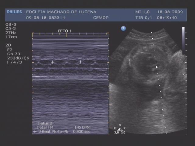 Fig 14 : Feto 1 Imagem ultrassonográfica da
