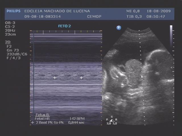 Fig 15 : Feto 2 - Imagem ultrassonográfica
