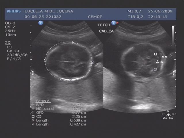 Fig. 1: Feto 1 Imagem ultrassonográfica do polo cefálico