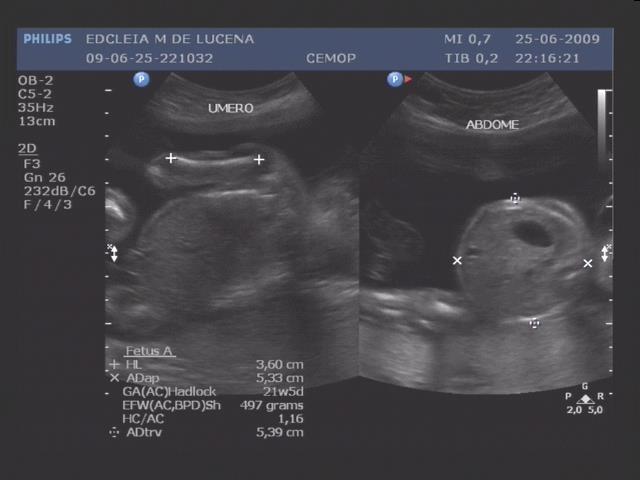 avaliação da fossa posterior. Fig.