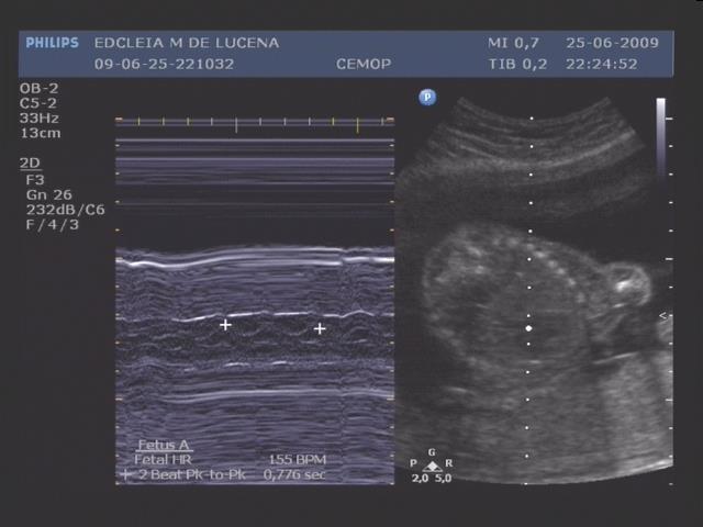 fêmur e a circunferência abdominal.