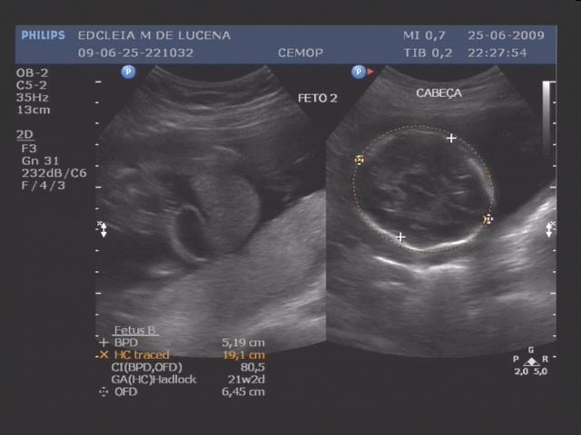 O feto 2 não apresentou alterações no polo cefálico (Figura 5), nem nos membros superiores e inferiores (Figura