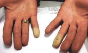 26 Figura 2.4 Fenômeno de Raynaud ou doença dos dedos brancos. Fonte: SILVA et al. (2011). Segundo Fiedler et al.