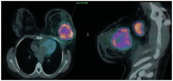 Dessa forma, essa área da medicina, a Medicina Nuclear, tem sofrido grandes transformações se mostrando de grande valia para diagnósticos mais complexos e de varias patologias como o câncer de mama.