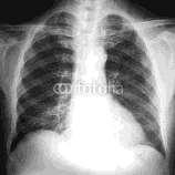 Radiografias Ao radiografar qualquer parte do corpo humano na radiografia que é um fino filme com brometo de prata (AgBr) ocorre a seguinte reação química: Ag (+1 0): redução Br (-1 0): oxidação