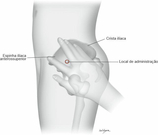 Figura 16.4 Locais de administração intramuscular no músculo glúteo (região dorsoglútea).