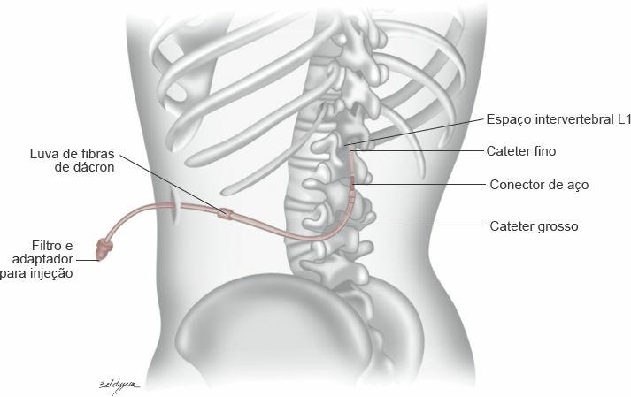 Figura 16.14 Escala numérica de dor. Figura 16.15 Local de inserção e posicionamento do cateter peridural no paciente. Figura 16.16 Escala de Ramsay.