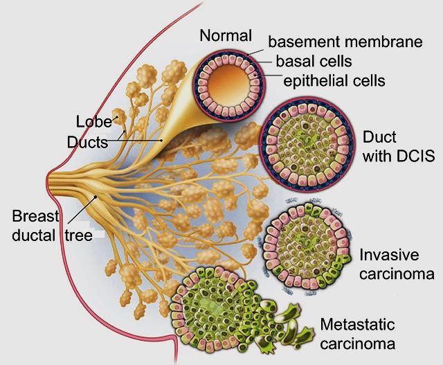 Parte dos carcinomas infiltrativos de mama evolui, após longo período, de lesões benignas pré-existentes, passando por lesões precursoras pré-malignas, carcinoma in situ e carcinoma microinvasivo