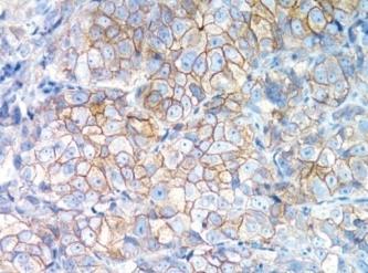 Na avaliação histológica de biópsia ou de ressecção cirúrgica a imunohistoquímica é a técnica mais utilizada na rotina, por ser mais simples, rápida e relativamente barata (118).