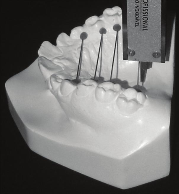 Profundidade ao nível dos primeiros molares: medida vertical em milímetros da linha média palatina até o fio de aço inox que une a região dos primeiros molares superiores (Figura 8).