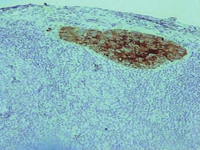 Avaliação pela técnica de imunohistoquímica (AE1/AE3), magnificação original = 400 vezes. Figura 14.