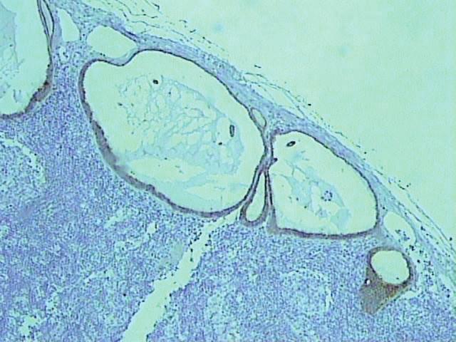 Avaliação pela técnica de imunohistoquímica (AE1/AE3), magnificação original = 400 vezes. Figura 16.